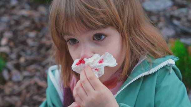  Носовое кровотечение у ребенка: какие факторы могут вызвать?